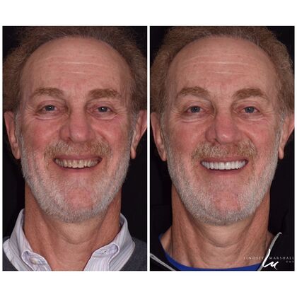 Before And After Transformations Case 37