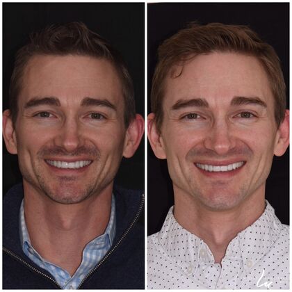 Before And After Transformations Case 39