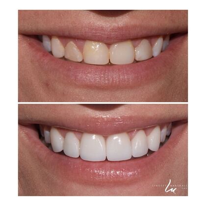 Before And After Transformations Case 41