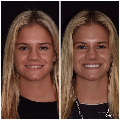 Before And After Transformations Case 42