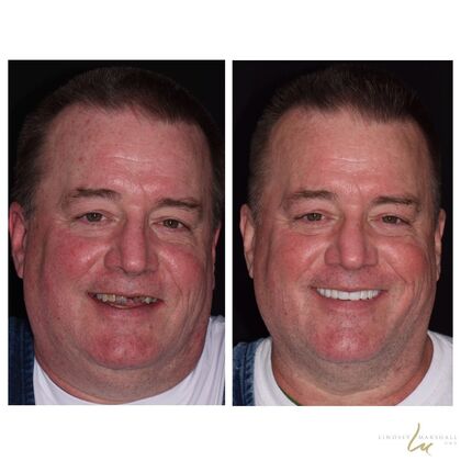 Before And After Transformations Case 43