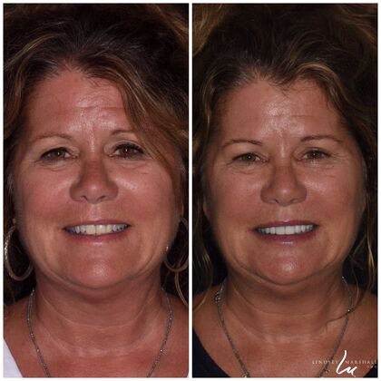 Before And After Transformations Case 44