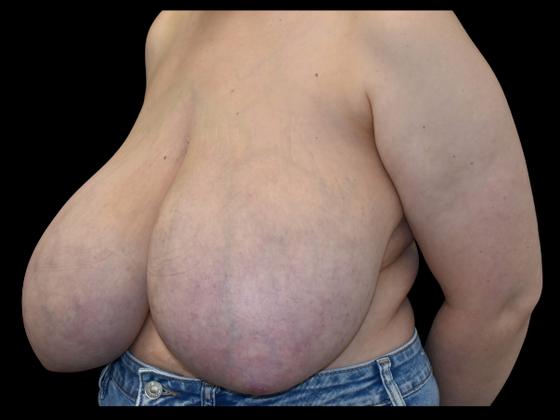 Breast Reduction: Case 2 - Before