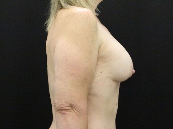 Breast Augmentation: Case 26 - After