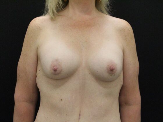 Breast Augmentation Case 26 - After