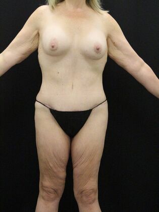 Tummy Tuck Case 32 - After