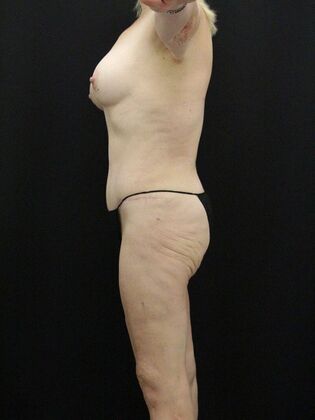 Tummy Tuck: Case 32 - After