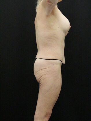 Tummy Tuck: Case 32 - After