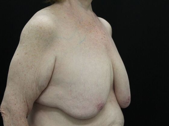 Breast Reduction & Lift: Case 21 - Before