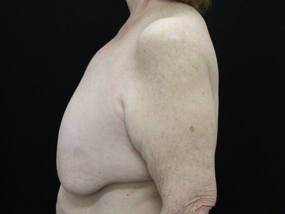 Breast Reduction & Lift: Case 21 - Before