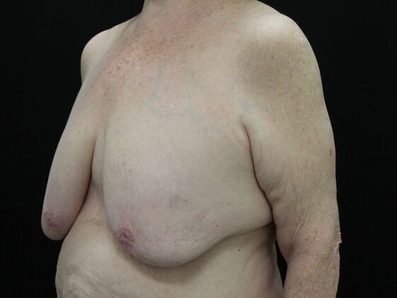 Breast Reduction & Lift: Case 21 - Before