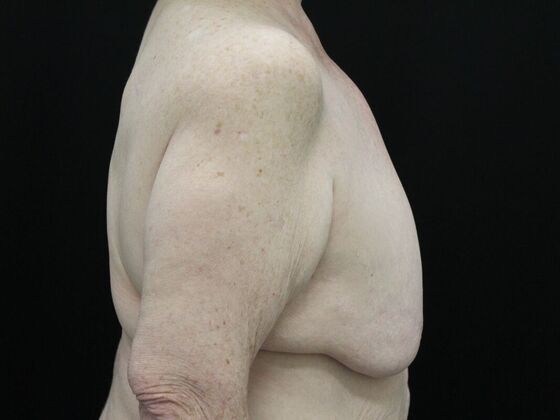 Breast Reduction & Lift: Case 21 - Before