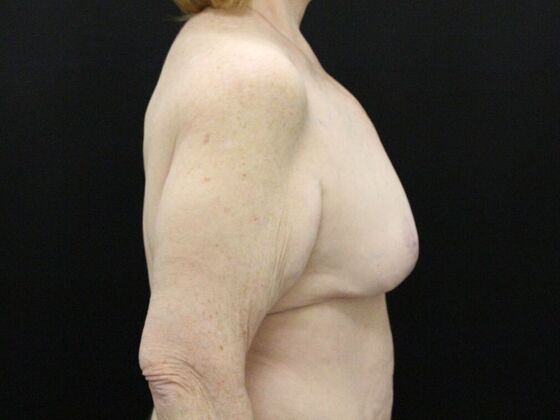 Breast Reduction & Lift: Case 21 - After
