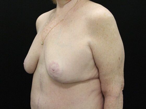 Breast Reduction & Lift: Case 21 - After