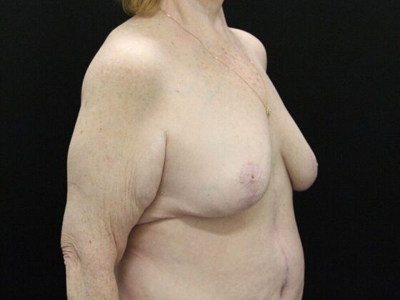 Breast Reduction & Lift: Case 21 - After