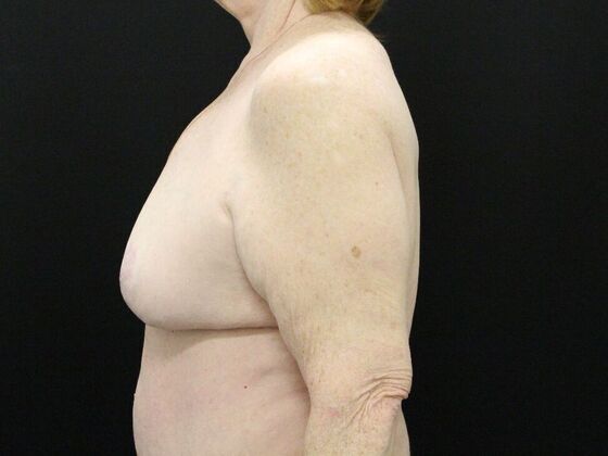 Breast Reduction & Lift: Case 21 - After