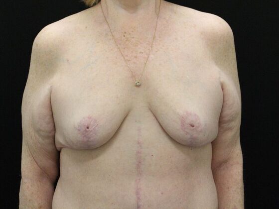 Breast Reduction & Lift Case 21 - After