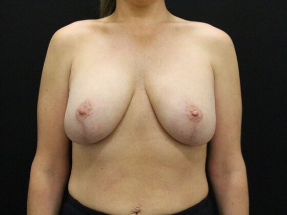 Breast Lift & Breast Lift Augmentation Case 21 - After