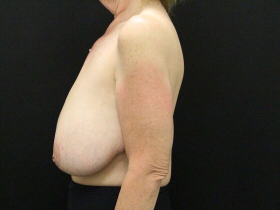 Breast Reduction & Lift: Case 22 - Before