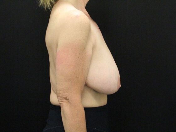 Breast Reduction & Lift: Case 22 - Before