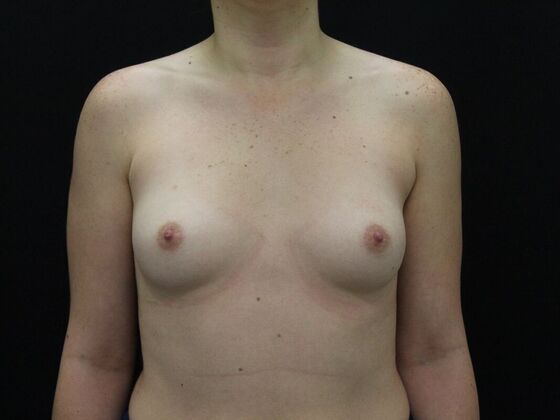 Breast Augmentation Case 34 - Before