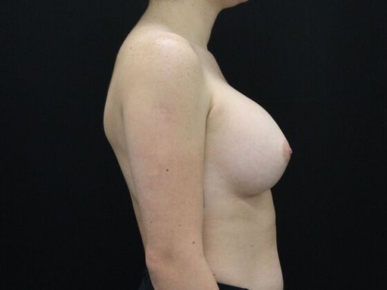 Breast Augmentation: Case 34 - After