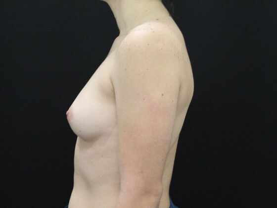 Breast Augmentation: Case 34 - Before