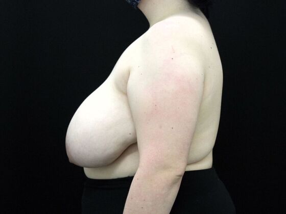 Breast Reduction & Lift: Case 23 - Before