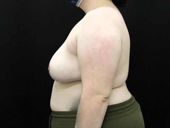 Breast Reduction & Lift: Case 23 - After