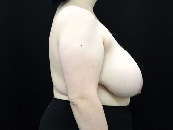 Breast Reduction & Lift: Case 23 - Before