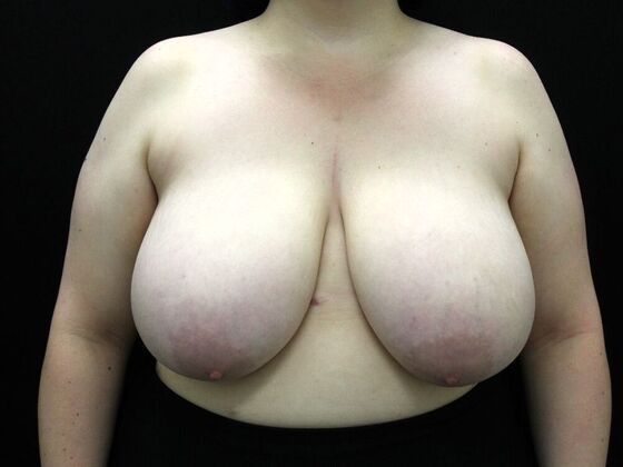 Breast Reduction & Lift Case 23 - Before