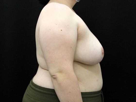 Breast Reduction & Lift: Case 23 - After