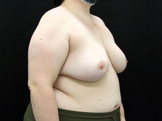 Breast Reduction & Lift: Case 23 - After