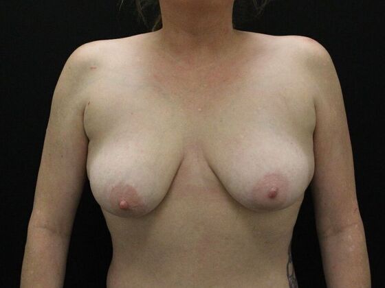 Breast Lift & Breast Lift Augmentation Case 36 - Before