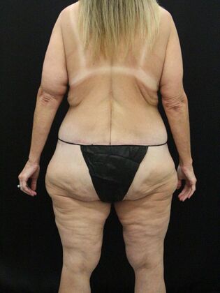 Body Lift: Case 6 - After