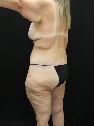 Body Lift: Case 6 - After