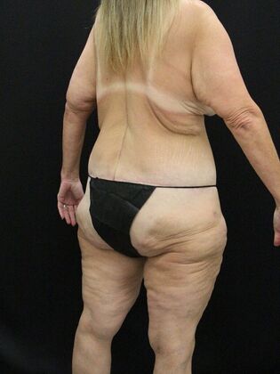 Body Lift: Case 6 - After