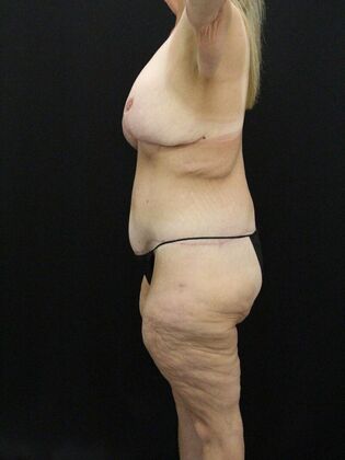 Body Lift: Case 6 - After