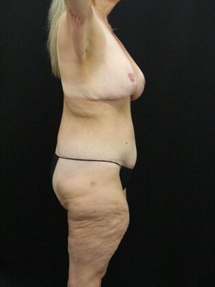 Body Lift: Case 6 - After