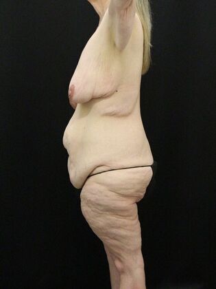 Body Lift: Case 6 - Before