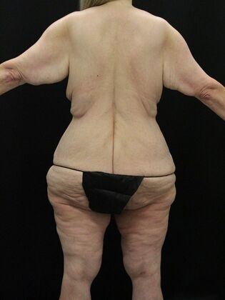 Body Lift: Case 6 - Before