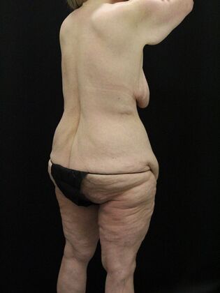 Body Lift: Case 6 - Before