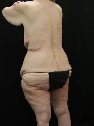 Body Lift: Case 6 - Before