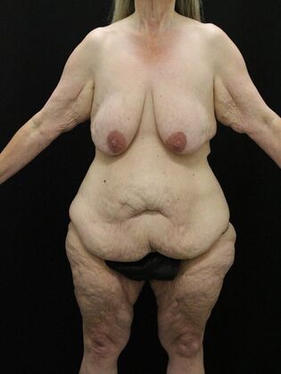 Body Lift: Case 6 - Before