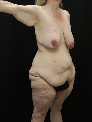 Body Lift: Case 6 - Before
