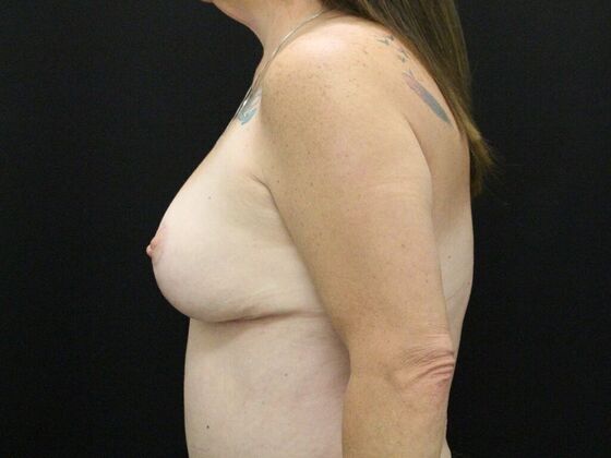 Breast Reduction & Lift: Case 25 - After