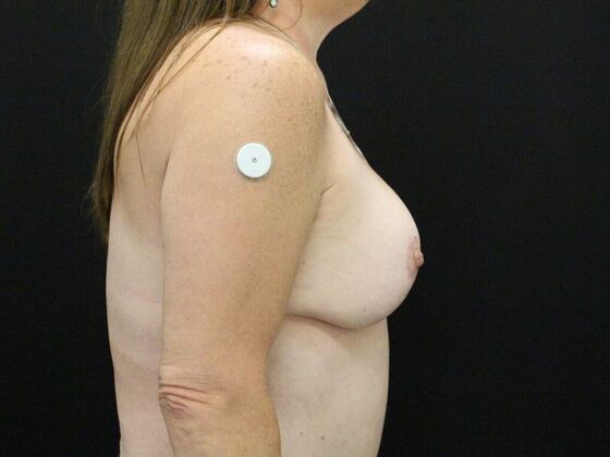 Breast Reduction & Lift: Case 25 - After