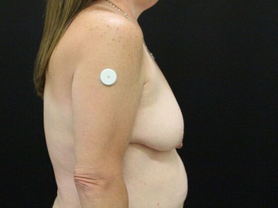 Breast Reduction & Lift: Case 25 - Before