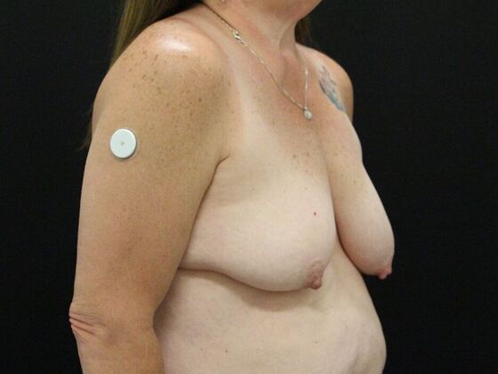 Breast Reduction & Lift: Case 25 - Before