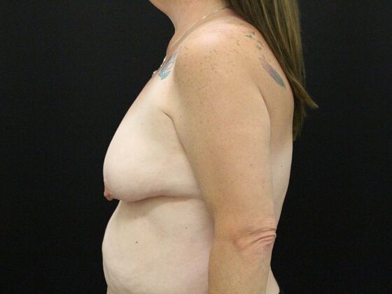 Breast Reduction & Lift: Case 25 - Before